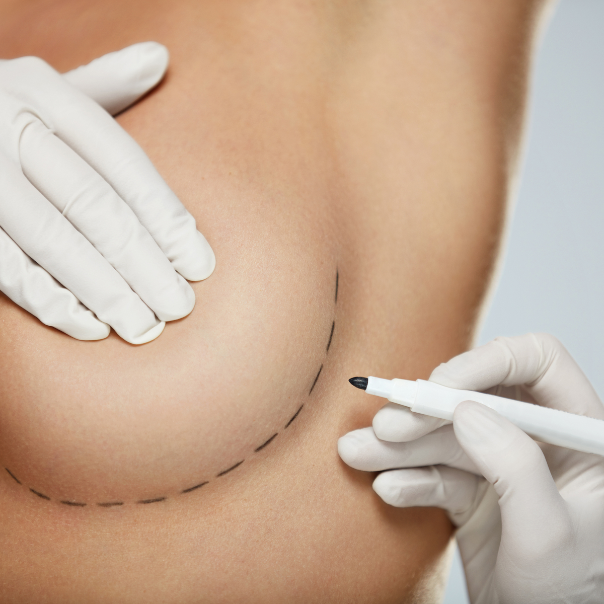 Breast Augmentation Safety