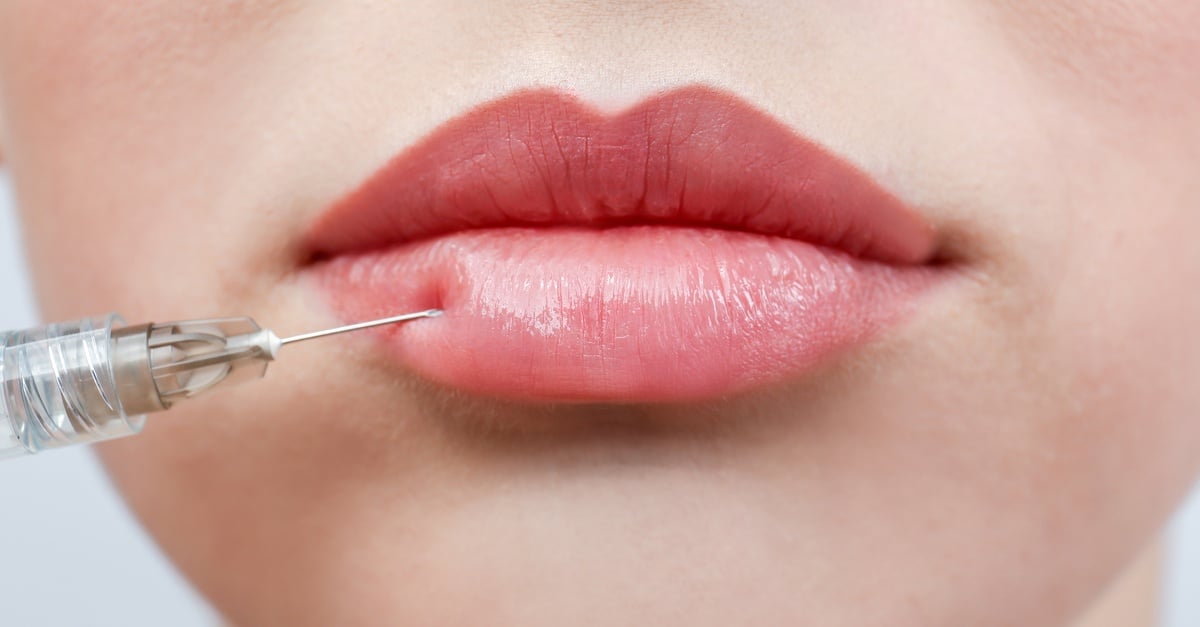 How Often Do I Need to Touch Up Dermal Fillers?