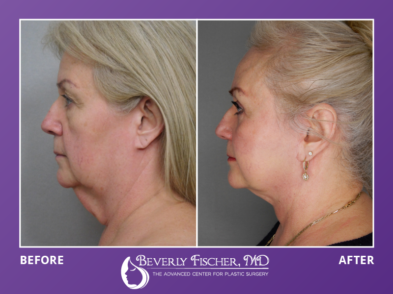 Dr. Beverly Fischer’s Top 8 Before & Afters